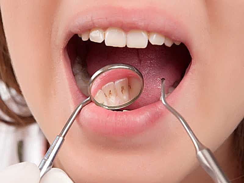 التهاب الأسنان.. قد يتطور إلى تسمم خطير